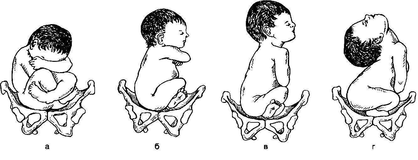 Что значит тазовое предлежание. Ягодичное предлежание плода позиция 1. Тазовое ножное предлежание плода. Варианты положения головки плода при тазовом предлежании. Тазовое предлежание плода позиции.